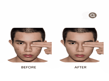 Organic Anti-Acne Three-Step System For Men - Moderate/Severe Acne Prone Skin